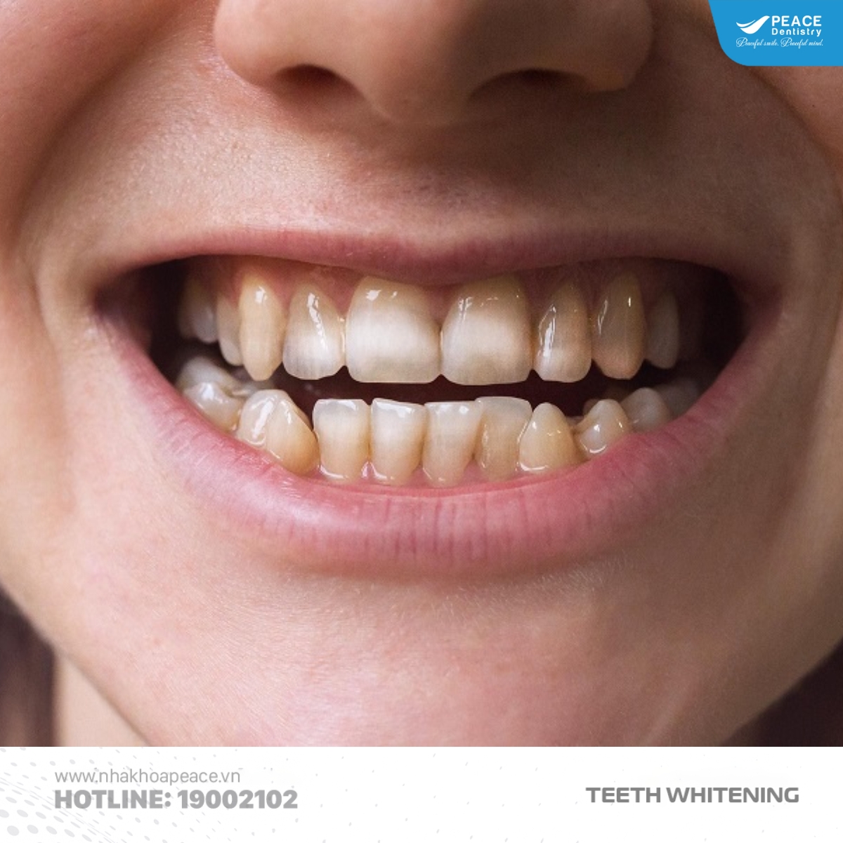 tẩy trắng sai cách khiến răng không đều màu