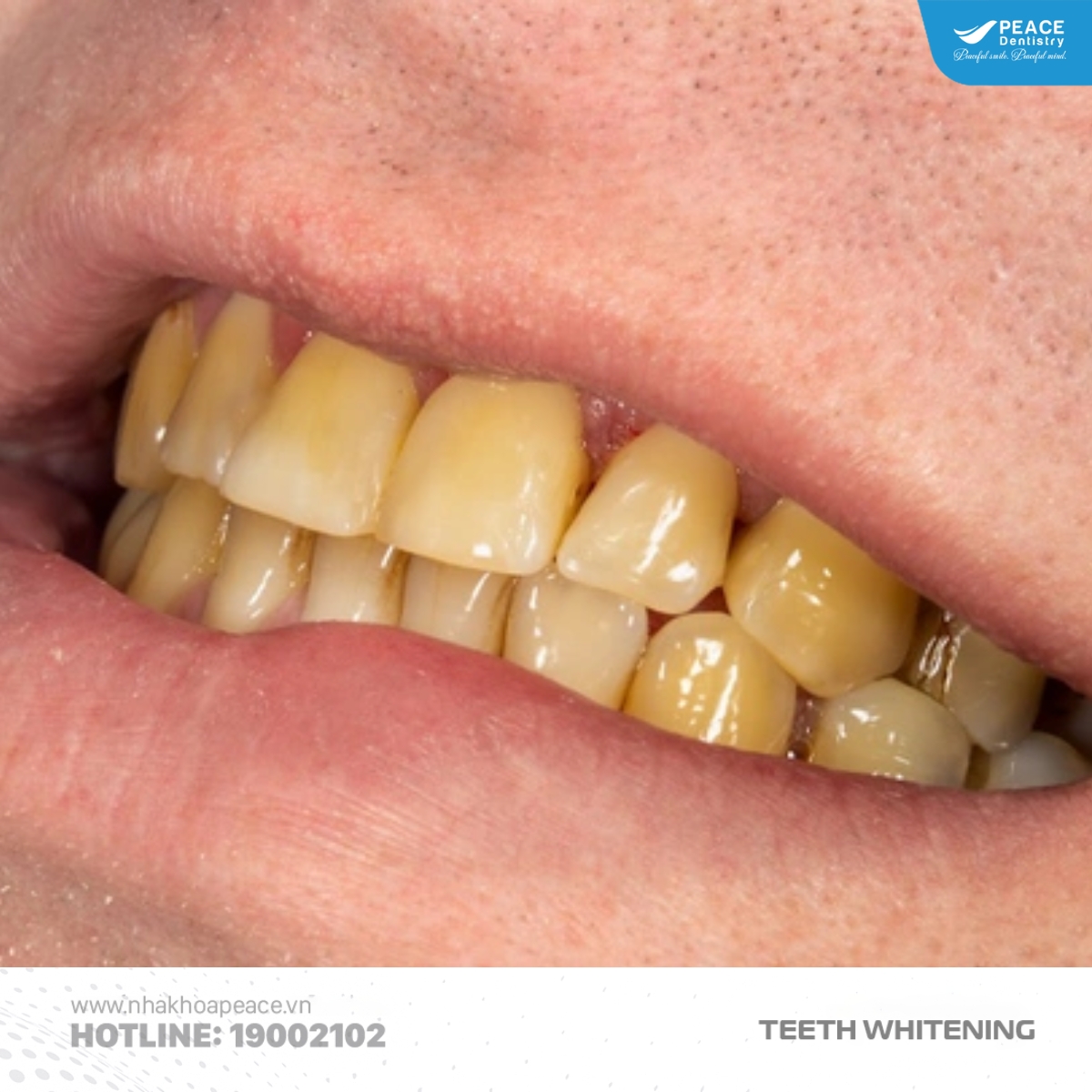 tình trạng răng miệng ảnh hưởng đến giá tẩy trắng răng