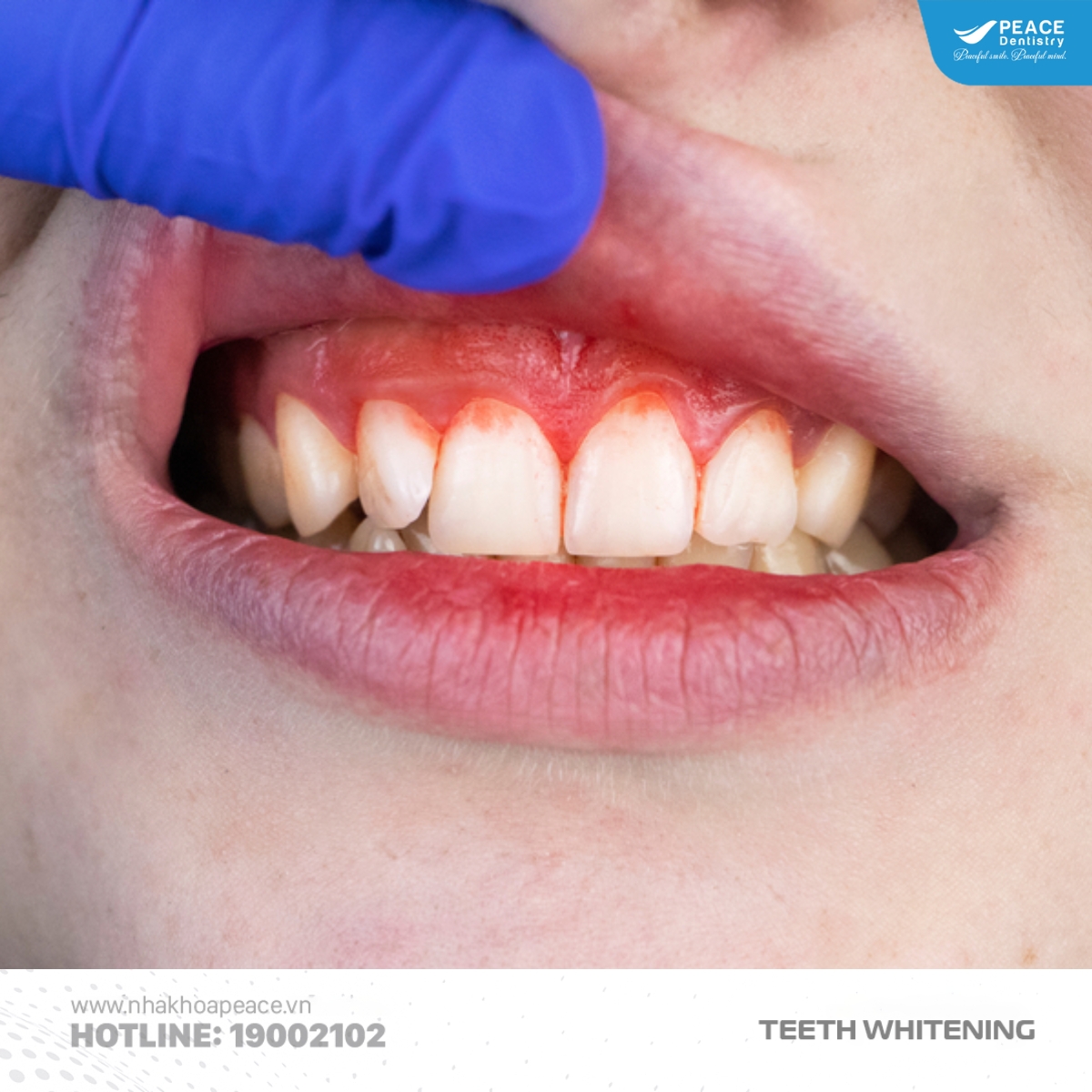 ưu nhược điểm của máng tẩy trắng răng