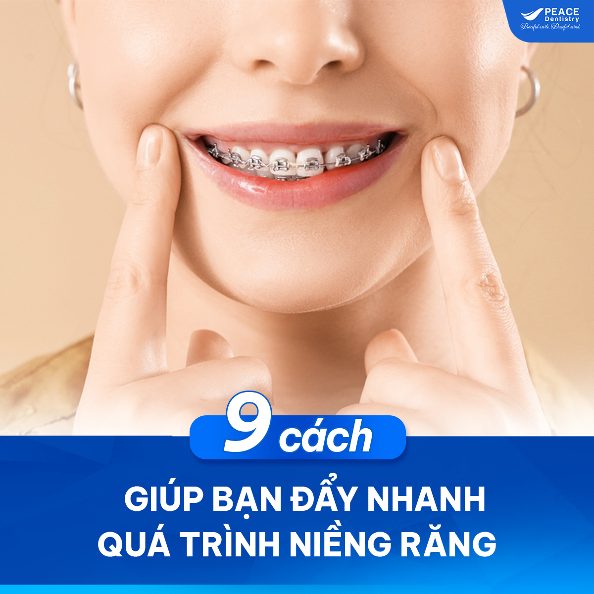cách đẩy nhanh tiến độ niềng răng