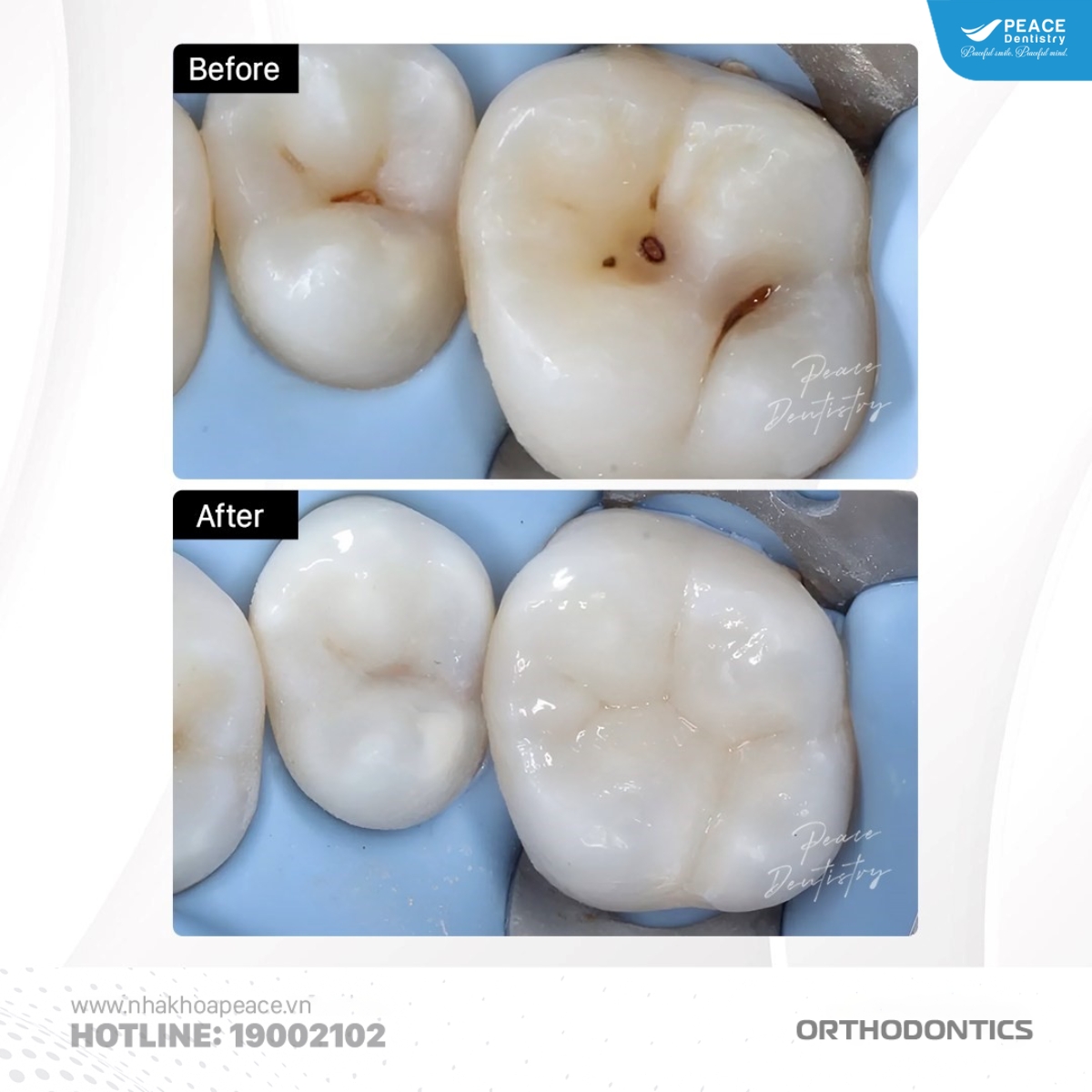 cách xử lý sâu răng khi niềng
