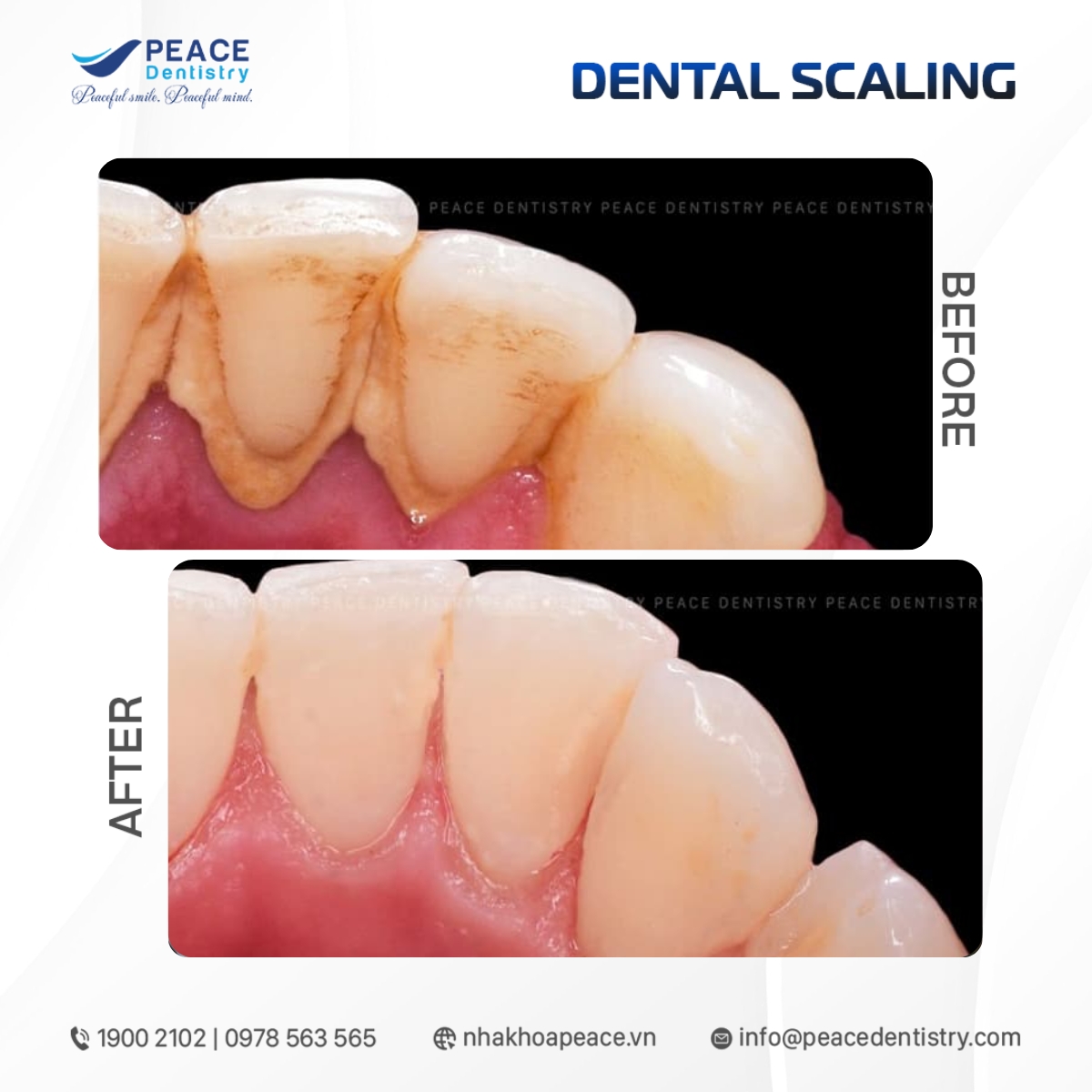 cạo vôi khắc phục răng ố vàng