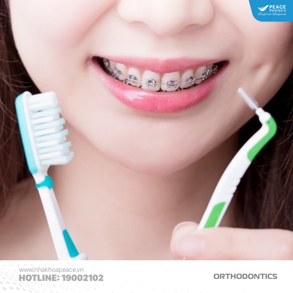 chăm sóc răng miệng đúng cách để đẩy nhanh tiến độ niềng răng