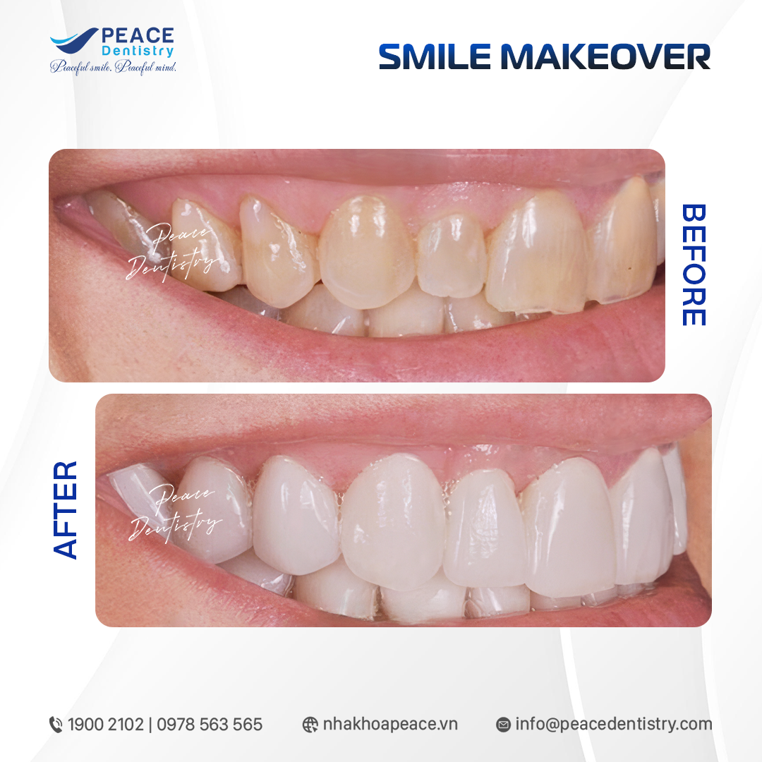 dán sứ veneer cho răng nhiễm tetra