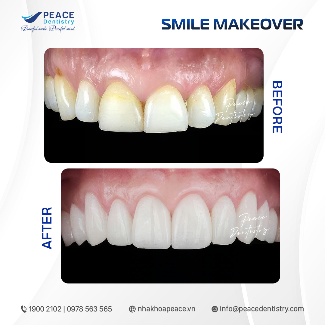 dán sứ veneer cho răng ố vàng