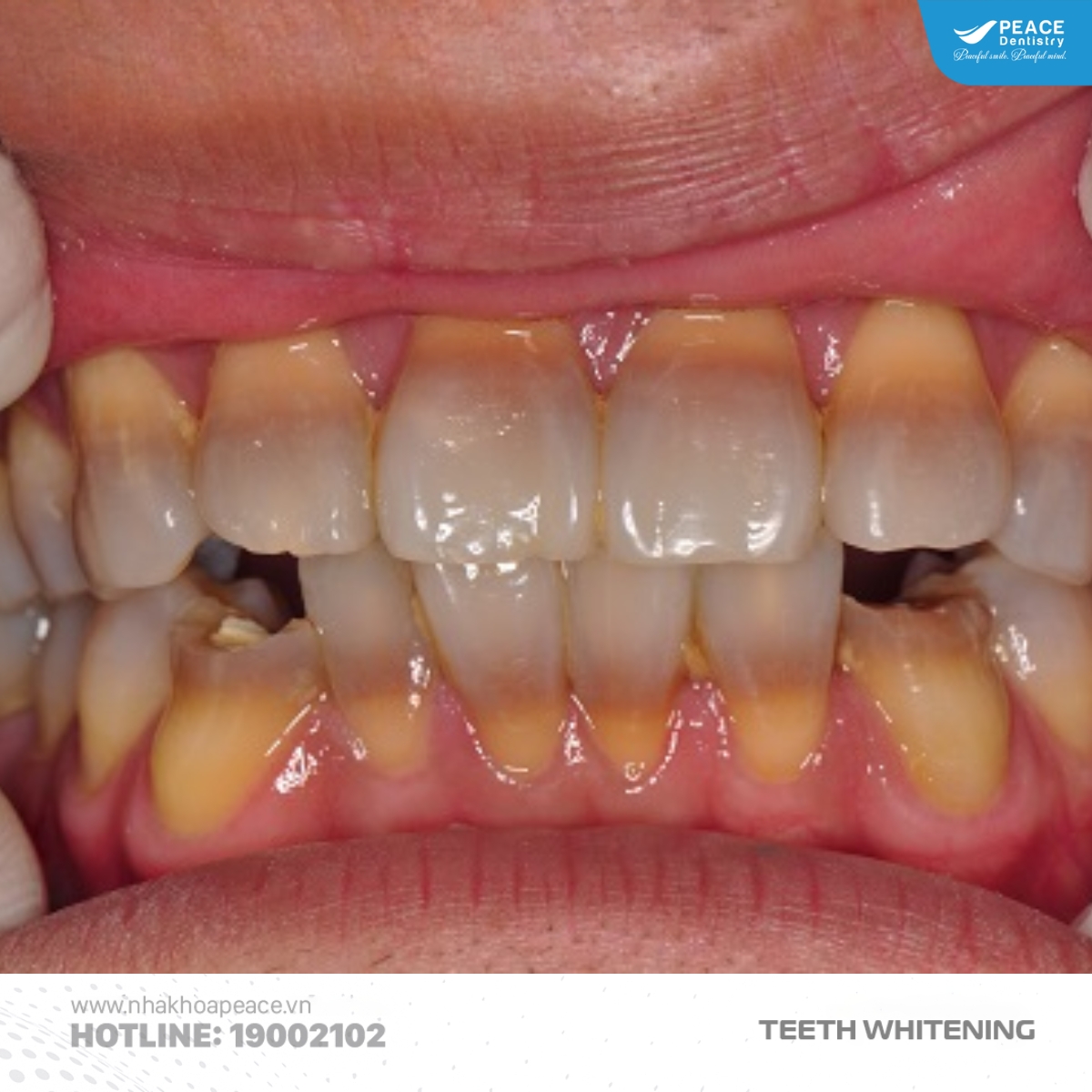 dấu hiệu nhận biết răng nhiễm tetra