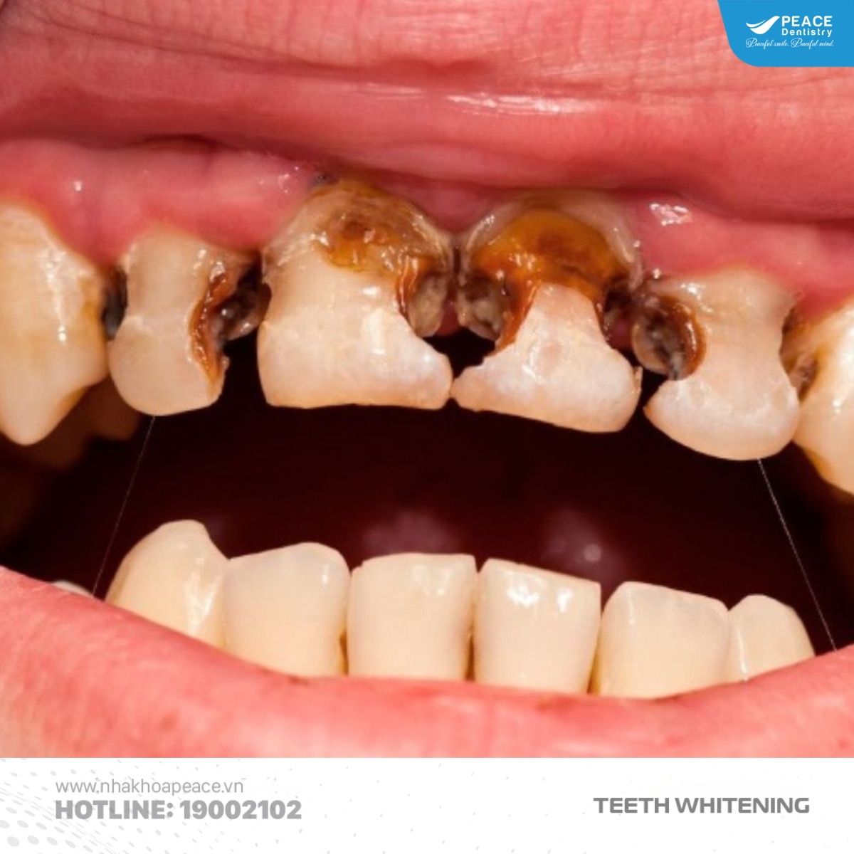 dấu hiệu nhận biết răng nhiễm tetracycline