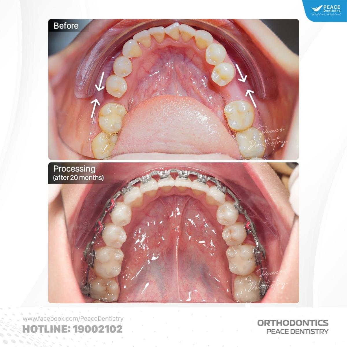 đóng khoảng răng mất bằng phương pháp niềng răng