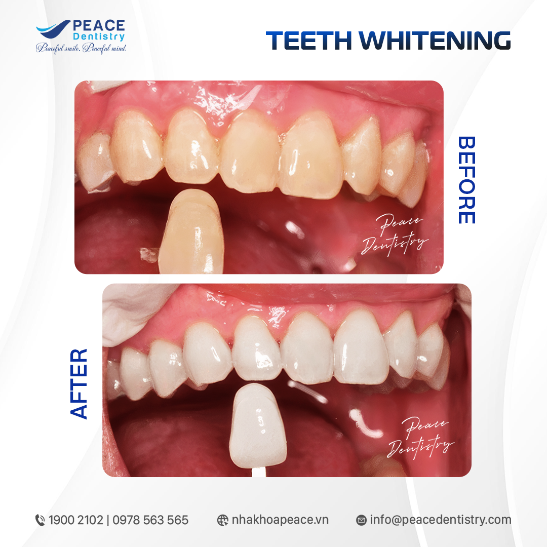 hiệu quả sau khi tẩy trắng răng