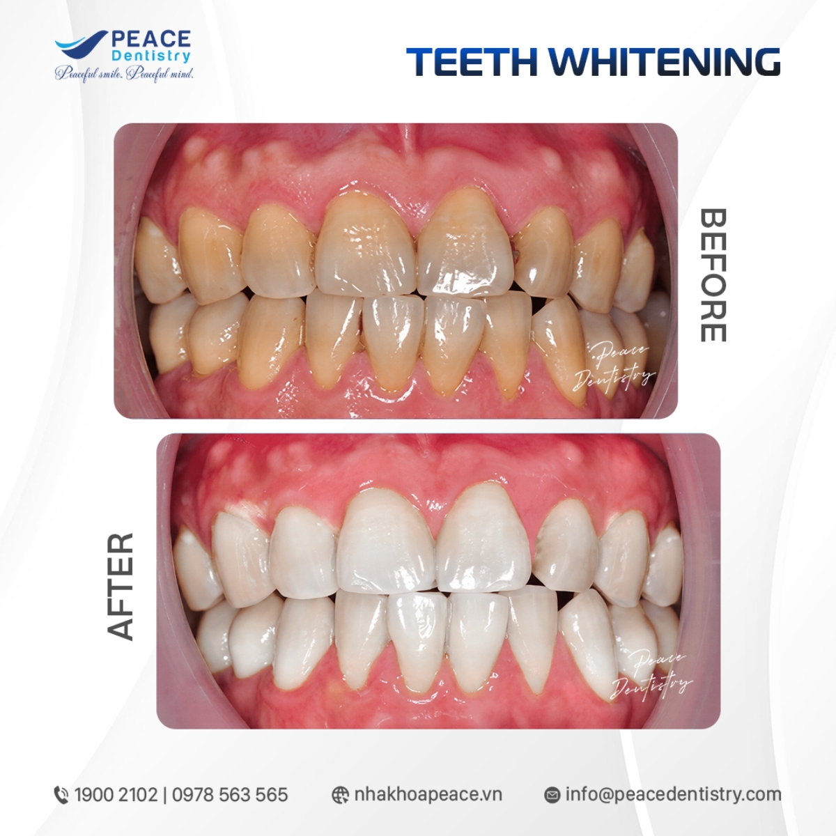 hình ảnh tẩy trắng cho răng đen