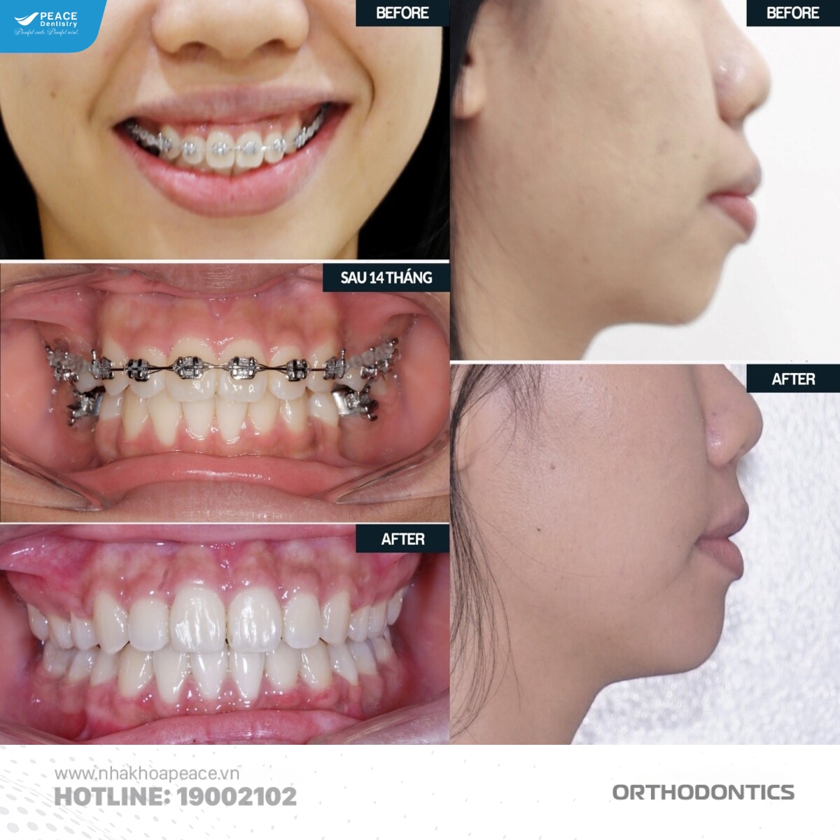 lựa chọn nha khoa uy tín để có kết quả niềng răng hiệu quả
