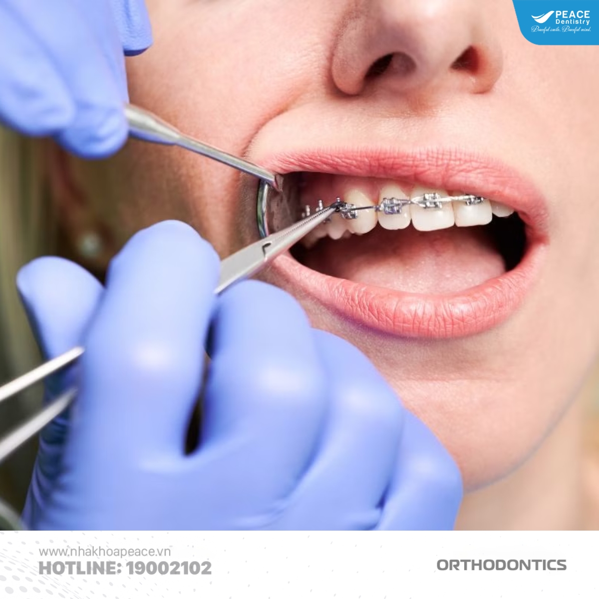 nguyên nhân niềng răng bị tiêu xương