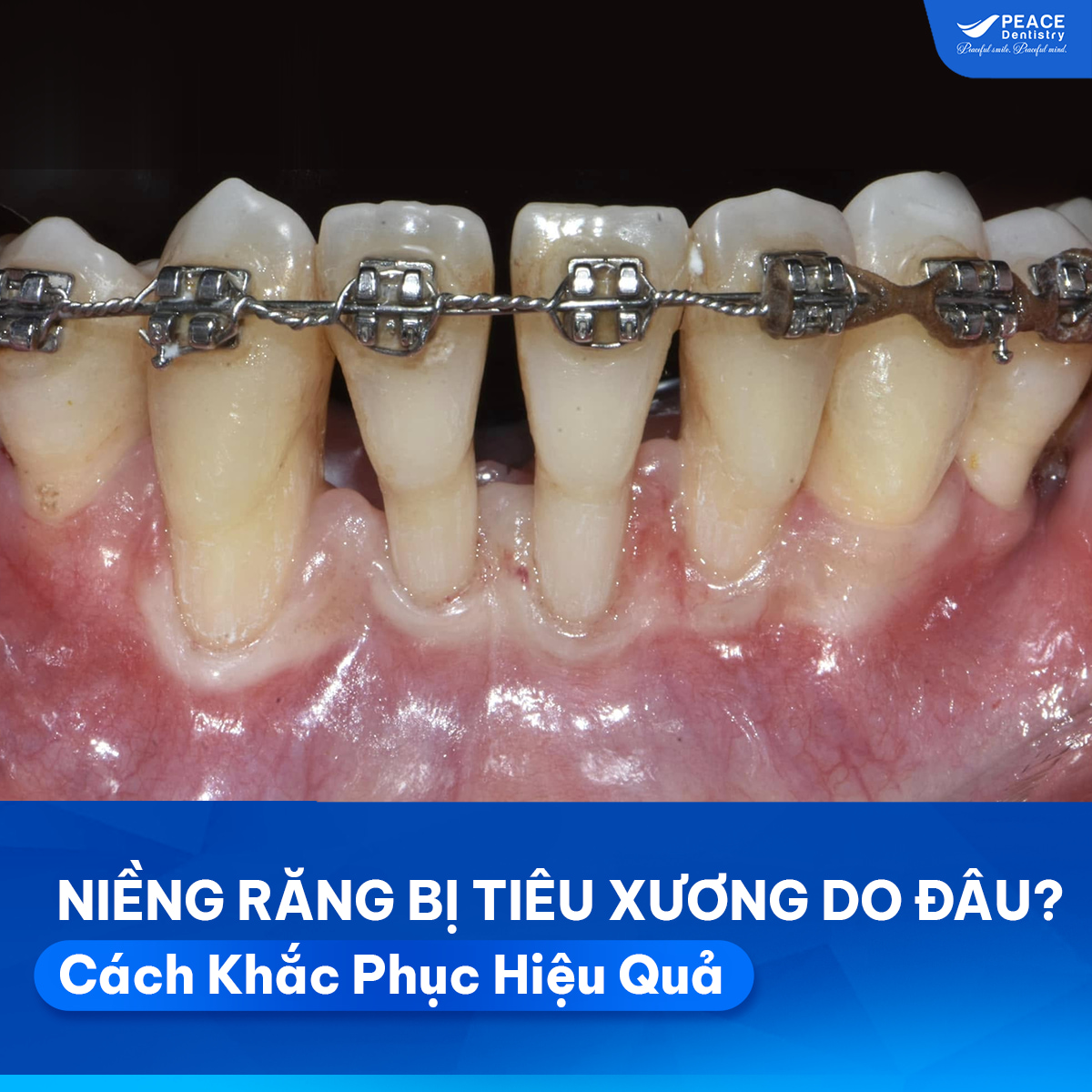 niềng răng bị tiêu xương