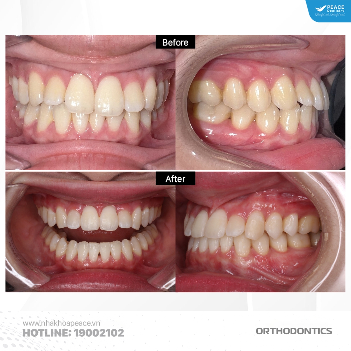 niềng răng cải thiện thẩm mỹ