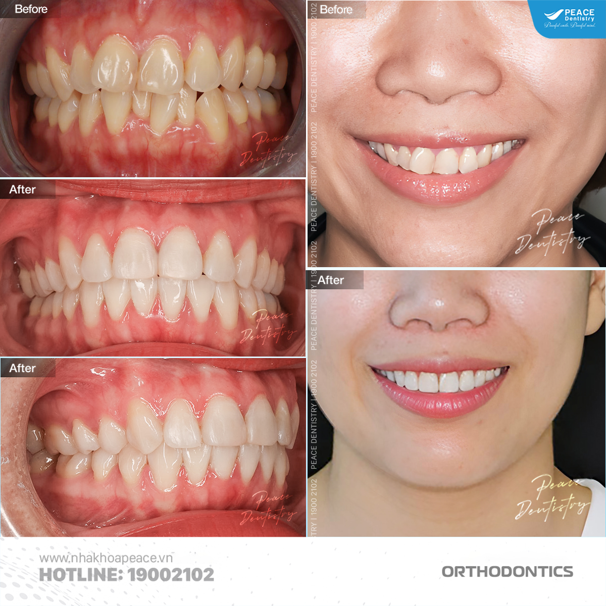 niềng răng cho trường hợp chen chúc sai lệch khớp cắn