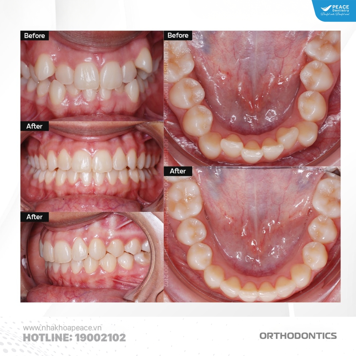 niềng răng cho trường hợp phức tạp