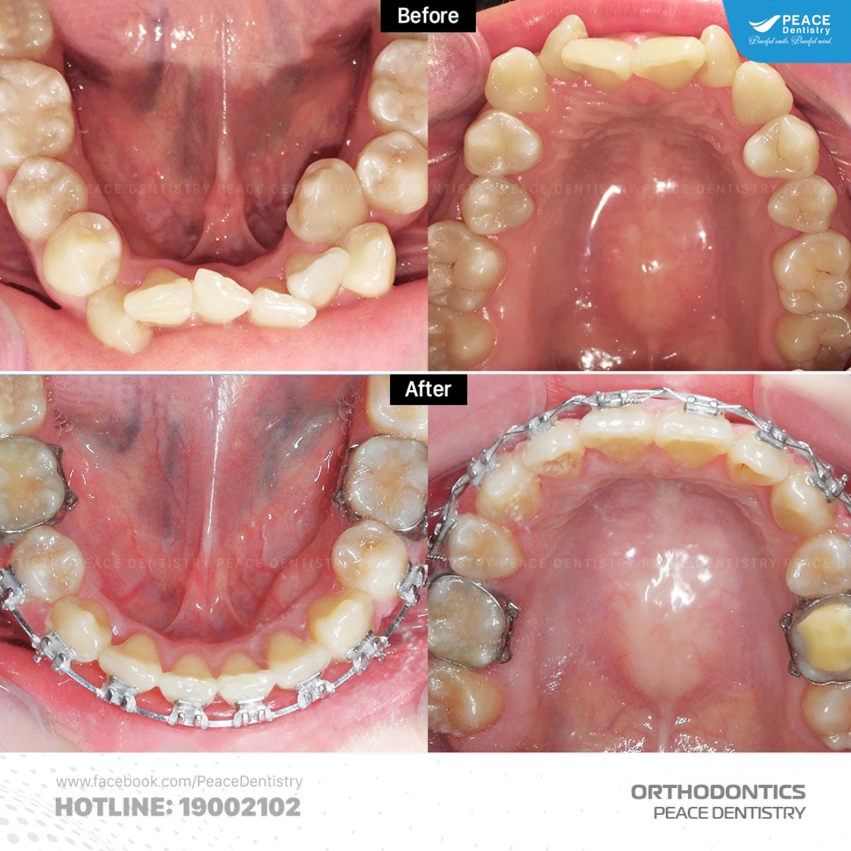 niềng răng cho trường hợp răng chen chúc