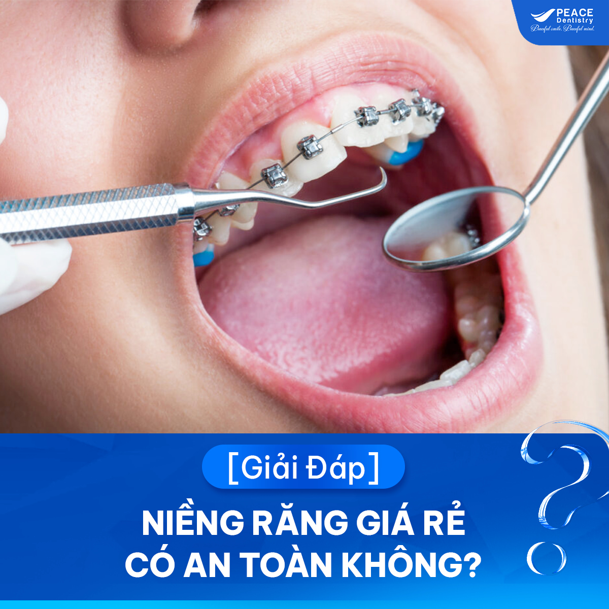 niềng răng giá rẻ