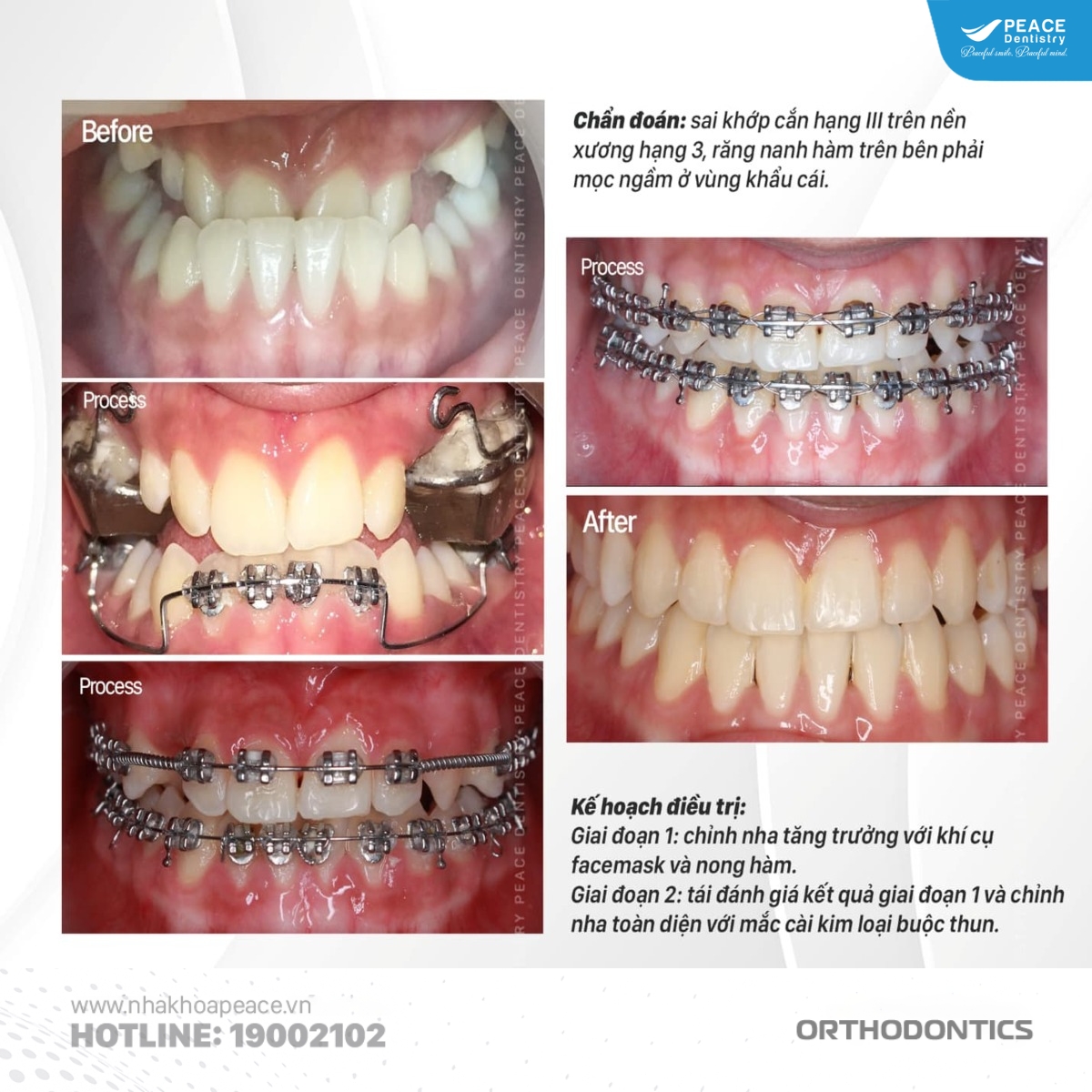 niềng răng kết hợp khí cụ