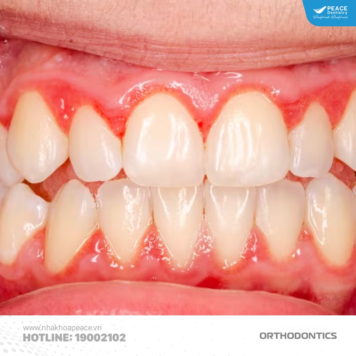 niềng răng không vệ sinh kỹ dễ gây bệnh lý