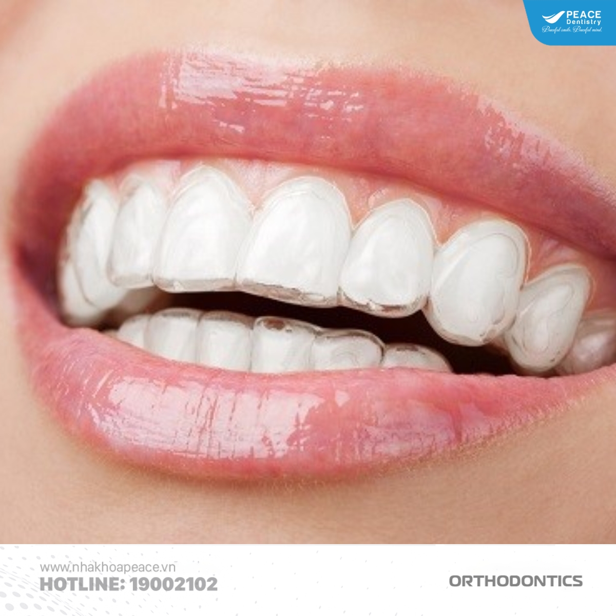 quy trình niềng răng bước 6