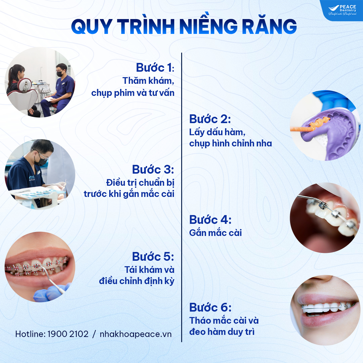 quy trình niềng răng tại peace dentistry