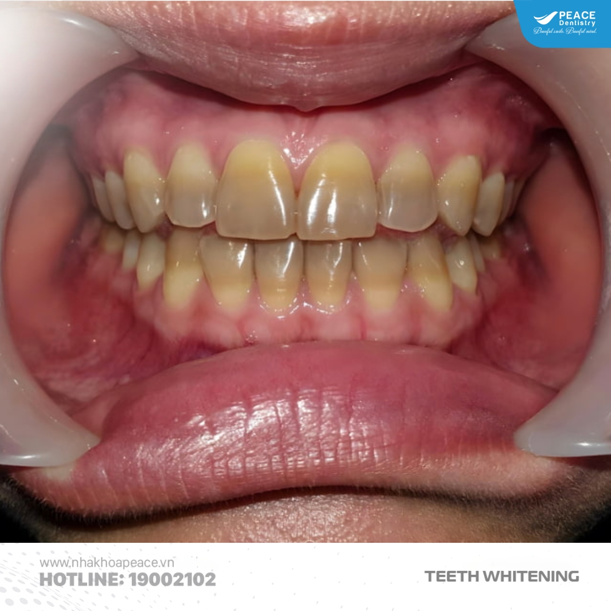 răng bị ố vàng do nhiễm tetracycline