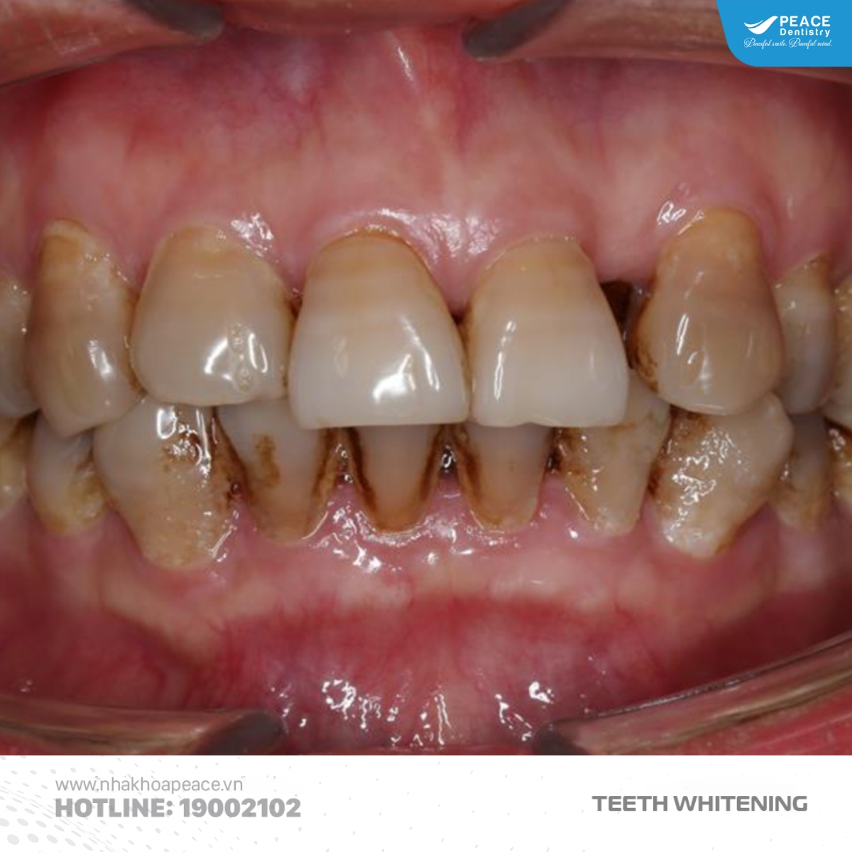 răng bị ố vàng do tuổi tác