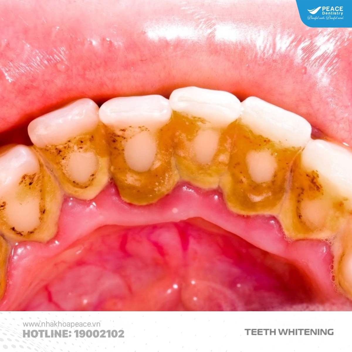 răng bị ố vàng do vệ sinh kém