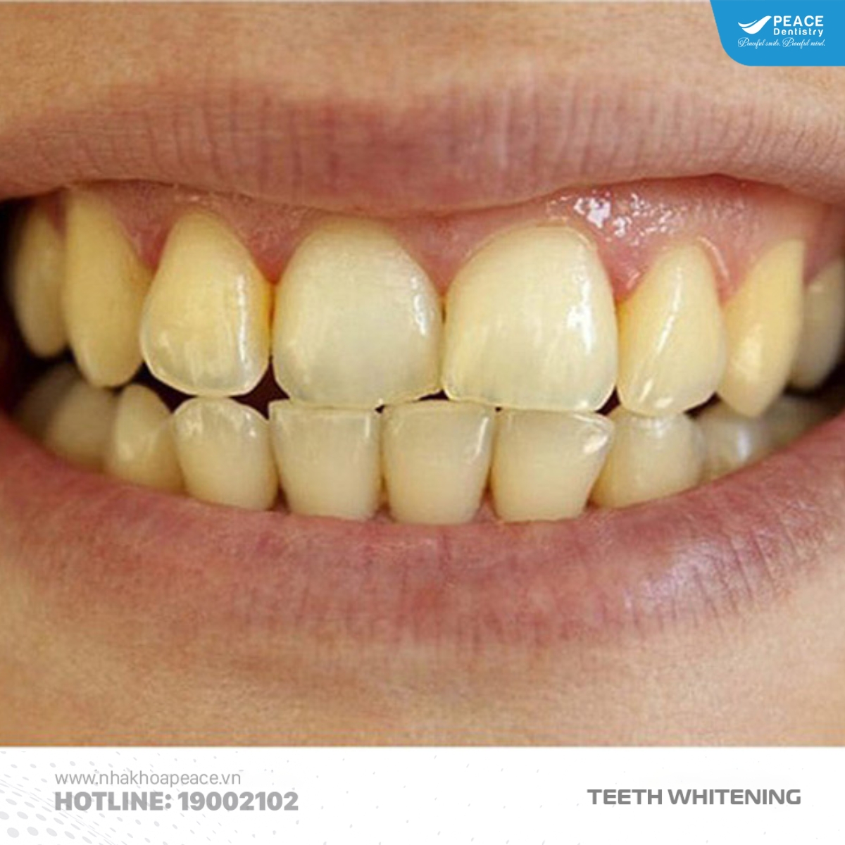 răng bị ố vàng