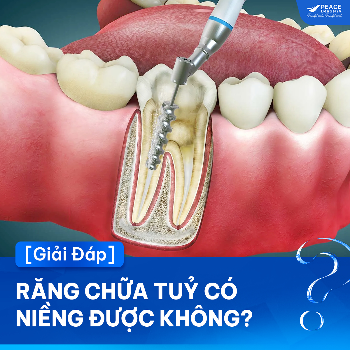 răng chữa tủy có niềng được không