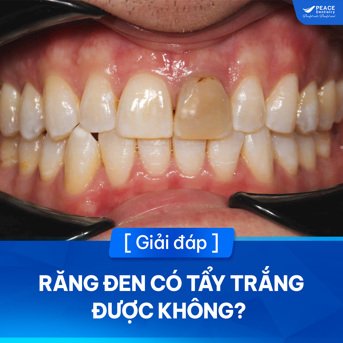 răng đen có tẩy trắng được không
