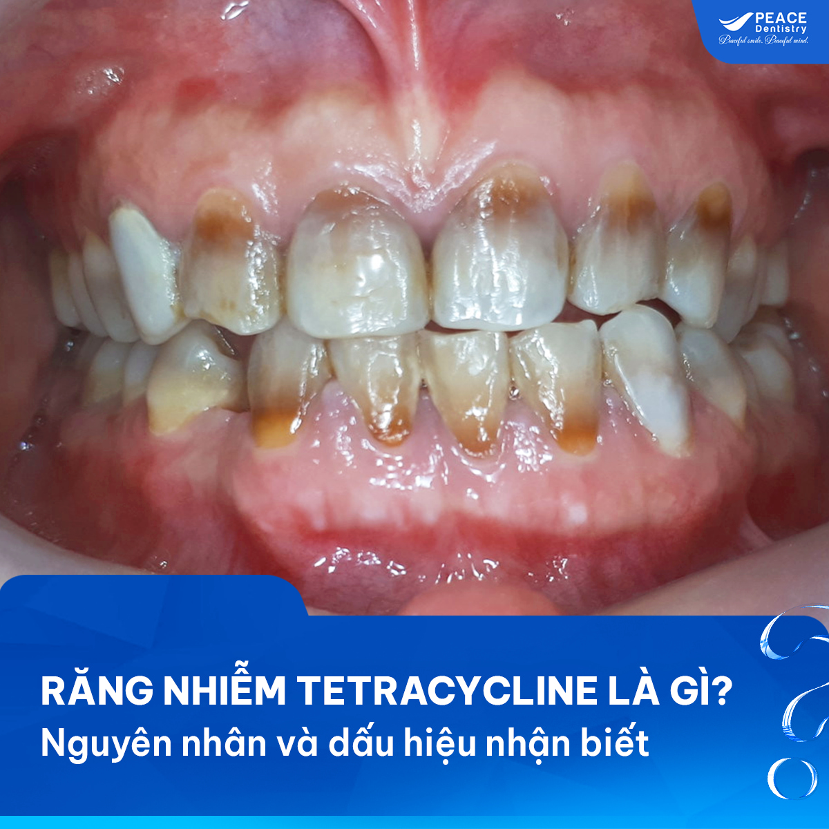 răng nhiễm tetracycline