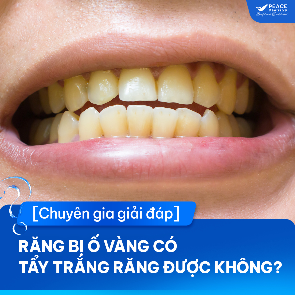 răng ố vàng có tẩy trắng được không
