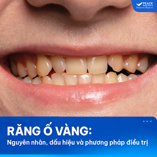 răng ố vàng