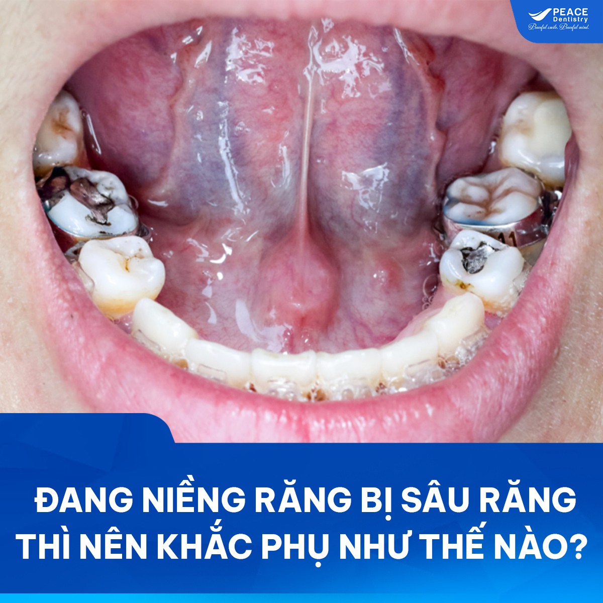 đang niềng răng mà bị sâu răng
