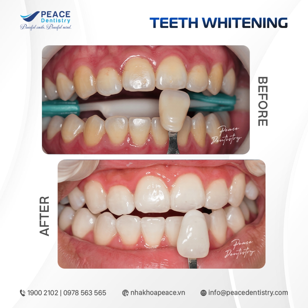 tẩy trắng răng bị ố vàng