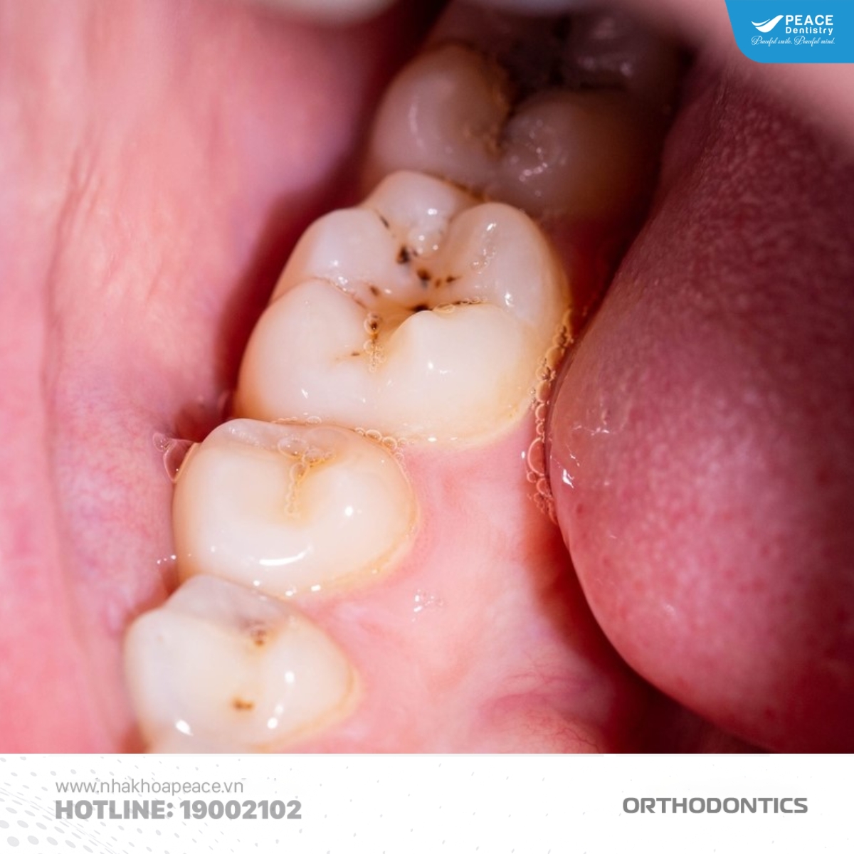 vì sao dễ bị sâu răng khi niềng