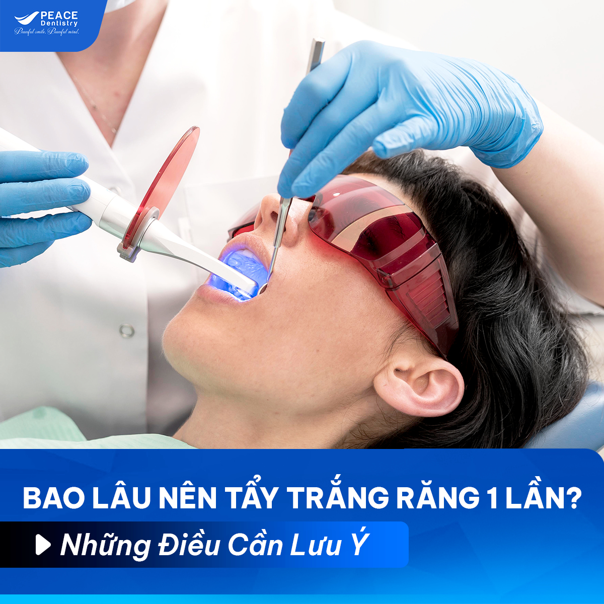 bao lâu nên tẩy trắng răng 1 lần