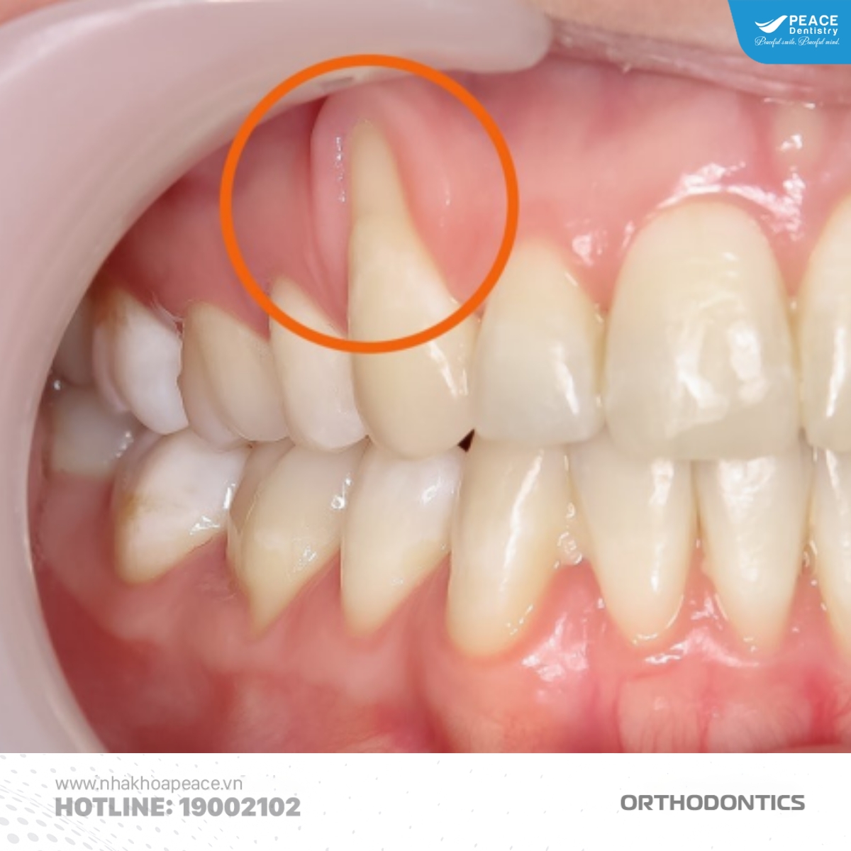 biến chứng khi niềng răng bị tụt lợi
