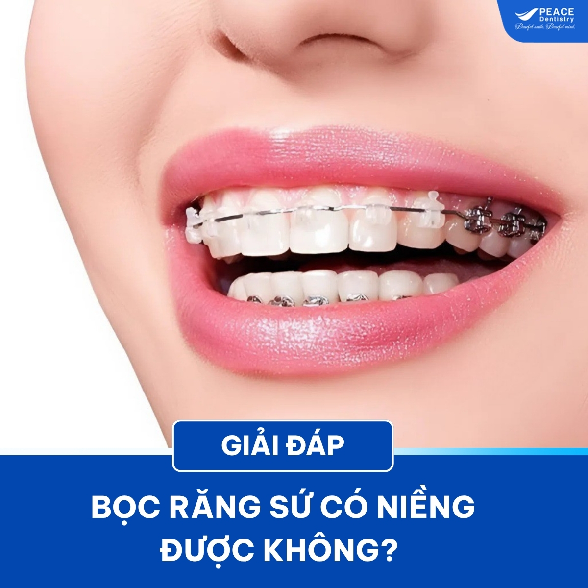 bọc răng sứ có niềng được không