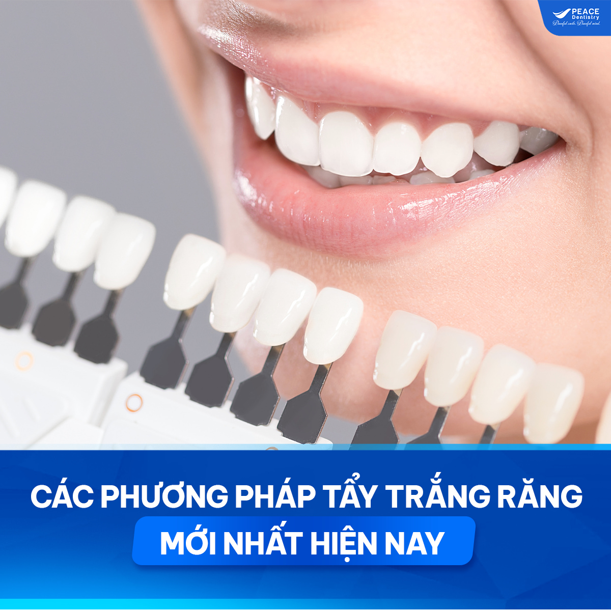 các phương pháp tẩy trắng răng