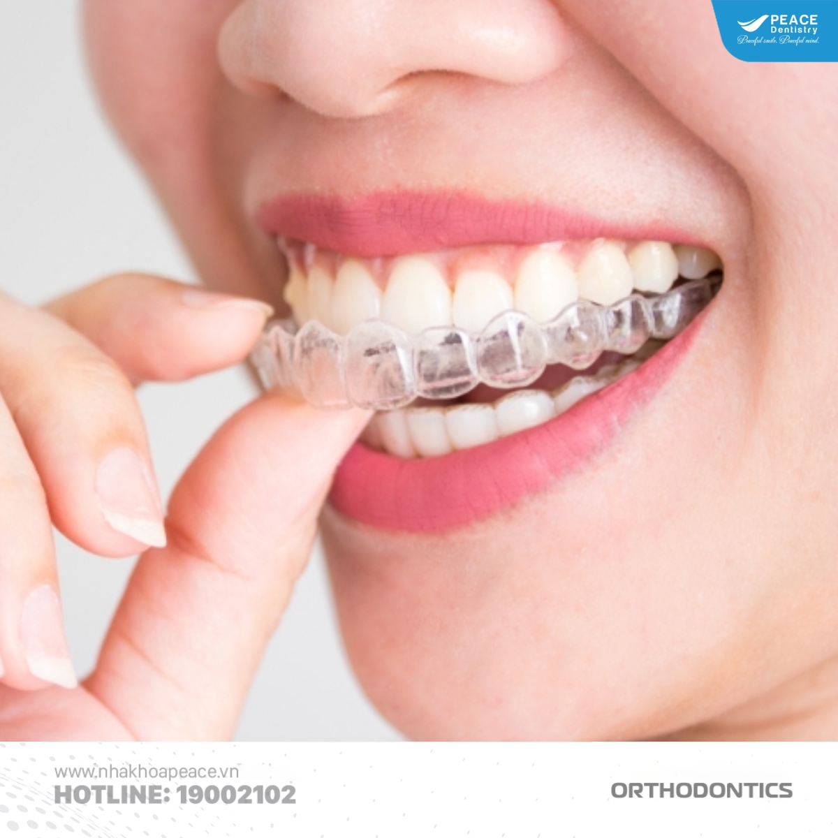 các yếu tố ảnh hưởng đến chi phí niềng răng 1 hàm