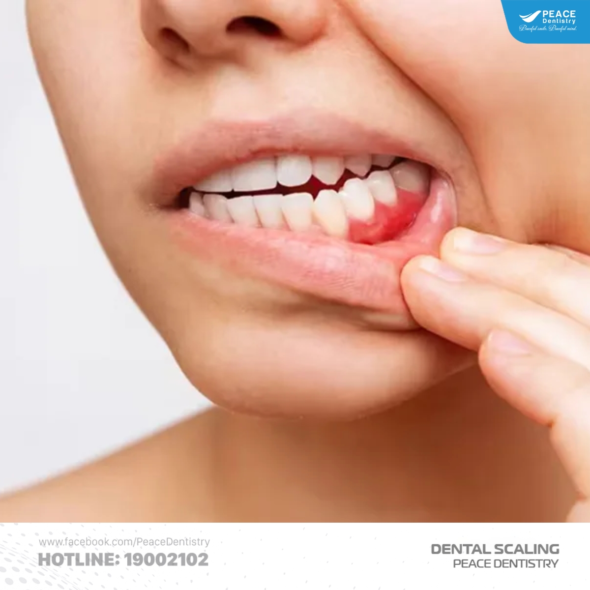 cạo vôi răng giúp ngăn ngừa vi khuẩn