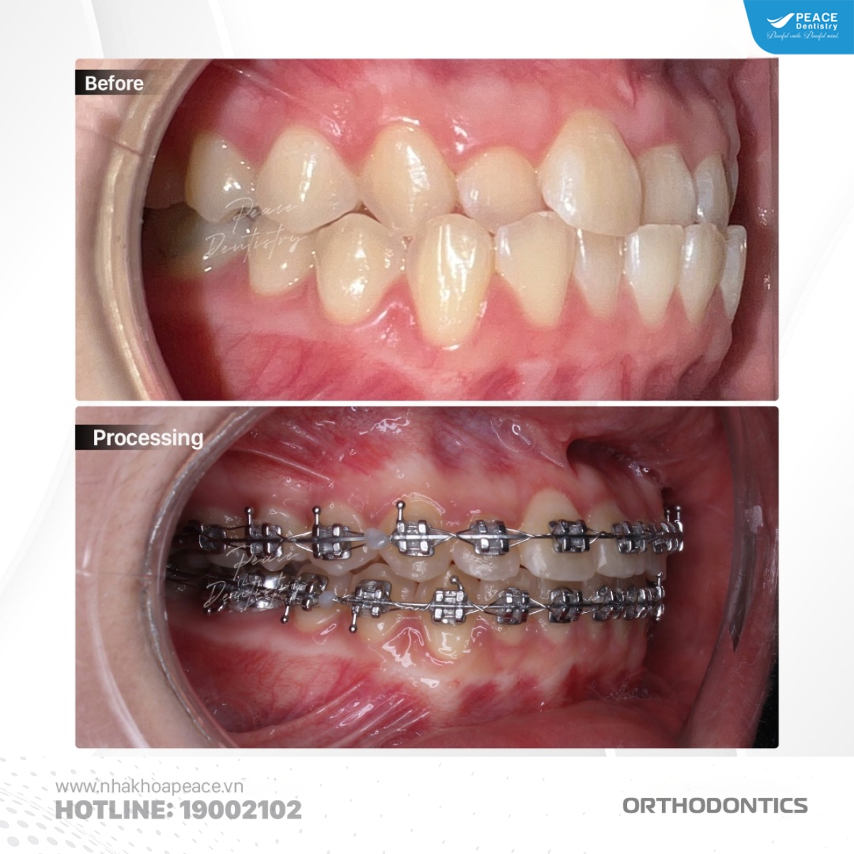 khớp cắn hạng 3 răng cửa cắn ngược