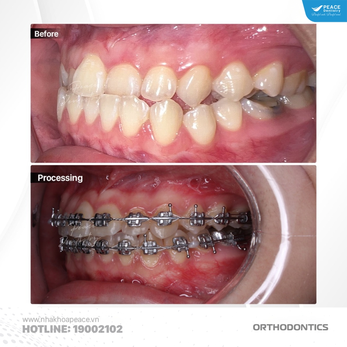 bác sĩ chỉ định niềng răng mắc cài kim loại