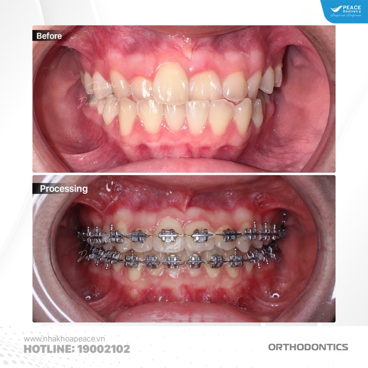 hình ảnh sau khi điều trị