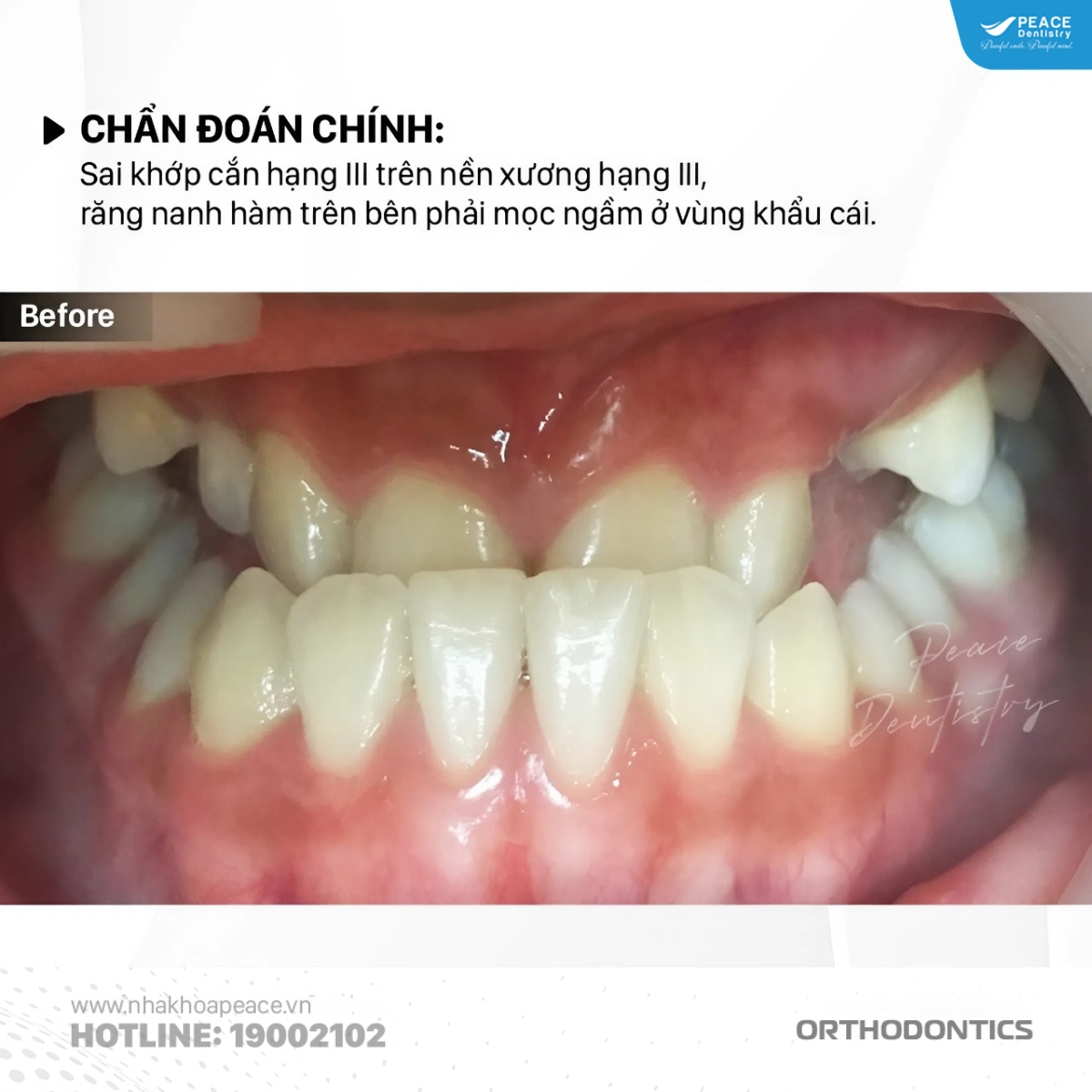 sai khớp cắn hạng 3 răng nanh hàm trên mọc ngầm