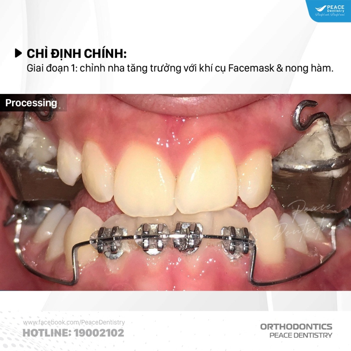 chỉnh nha bằng facemask