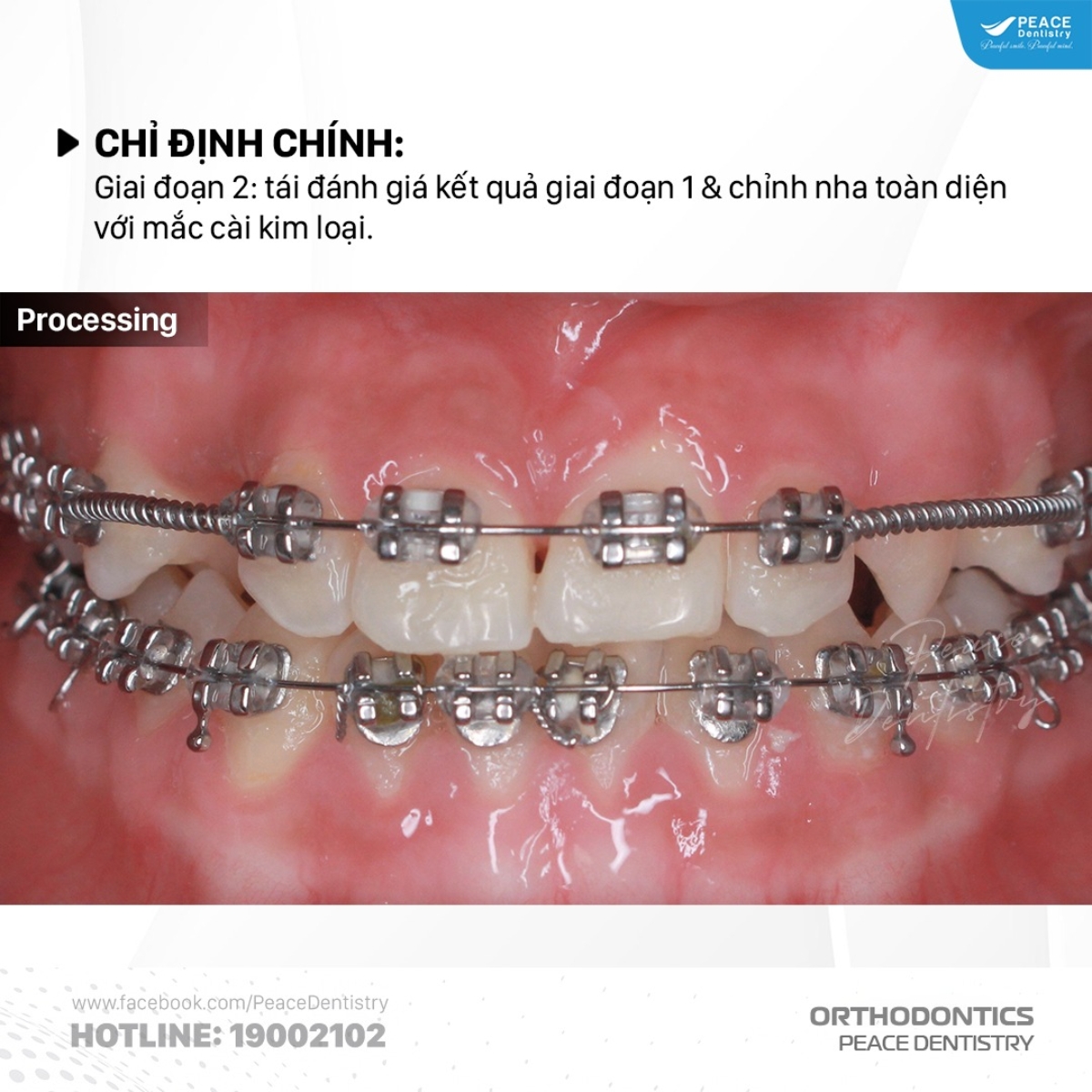 chỉnh nha bằng mắc cài kim loại
